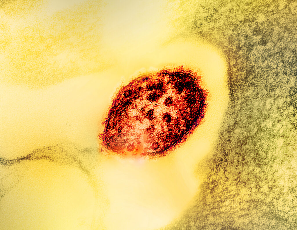 Electron microscope image of a single measles virion